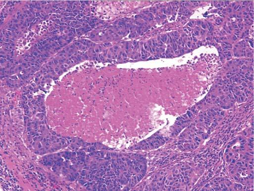 This tumor is characterized by a significantly decreased extent of squamous differentiation.