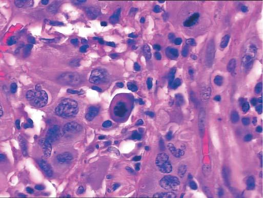 Central comedo-like areas of necrosis are a common feature (Figure 5-1C). However, generally the pavement-like appearance of tumor cells with sharply defined cell borders is still preserved.