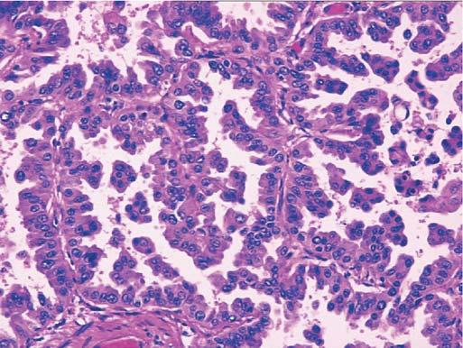 This well-differentiated tumor consists of well-formed glands lined by a single