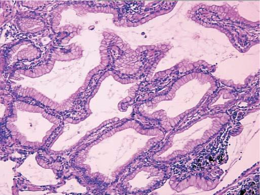 The characteristic lepidic growth pattern of bronchioloalveolar cell carcinoma is