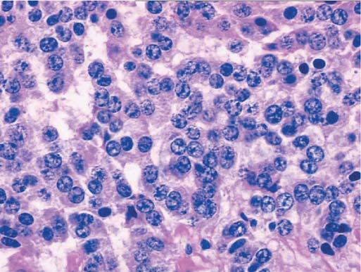 A well-differentiated neuroendocrine carcinoma ( carcinoid tumor) is composed of a monotonous population of small, round tumor