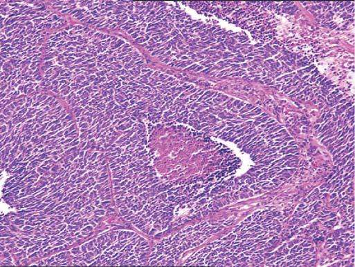A well-differentiated neuroendocrine carcinoma at a higher magnification.