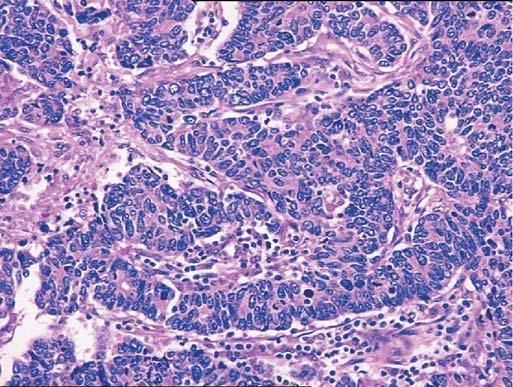 neuroendocrine carcinoma of the lung ( atypical carcinoid ). D.