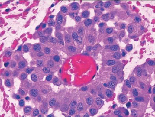 30 S. Suster and C. Moran A Figure 5-4. Malignant mesothelioma. A. This epithelioid mesothelioma is composed of large, round to polygonal tumor cells with abundant cytoplasm and minimal nuclear atypia.