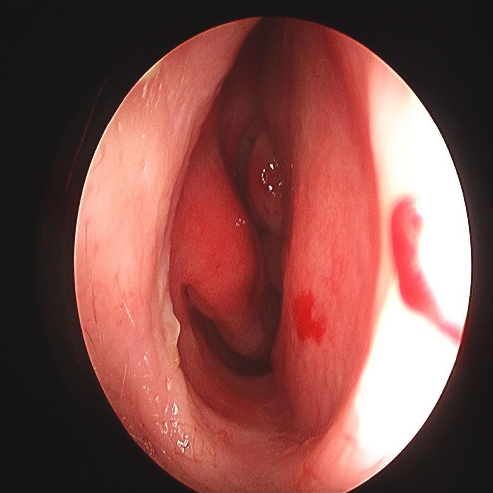 ENDOSCOPIC VIEW AT FRONT OF NOSE