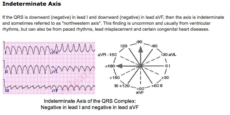 Indeterminate Axis or Northwest Axis 13 SVT or AV nodal re entry tachycardia (AVNRT) Classified based on site of origin (atria or AV node) or regularity