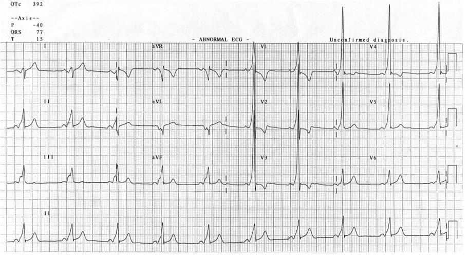 Other Pre Excitation Syndromes Lown Ganong Levine (LGL) syndrome Accessary pathway composed of James Fibres ECG PR interval < 120 ms Normal QRS morphology The term should not be used in the absence