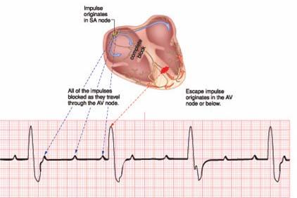 lead EKG lecture 5 AV Heart Blocks 3rd - degree AV heart block