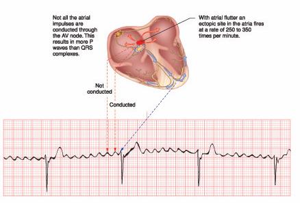Rapid Atrial Rates With Slow Ventricular Rates Because of the rapid rate not all atrial impulses are conducted through to the ventricles A slower than normal