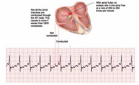 With Fast Ventricular Rates In addition to having either a normal or slow