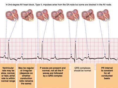resulting in atrial impulses that are not