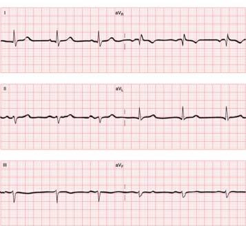 QRS is normal or if there is axis deviation 34