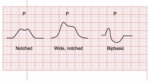 Right Atrial Enlargement 53 Different Looking Sinus P Waves Notched, wide (enlarged) or