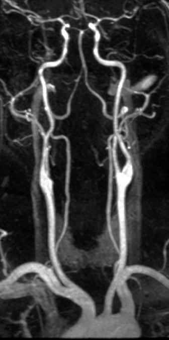 Vascular Imaging Arterial flow void