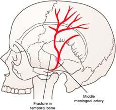 Skull fractures Significant force required Does not mean brain damage has occurred May have few or no signs of injury No fracture, still may have lethal injury Temporal area, causes severe damage