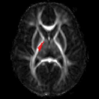 Longitudinal analysis of DTI: NLME Normative Infant WM Brain