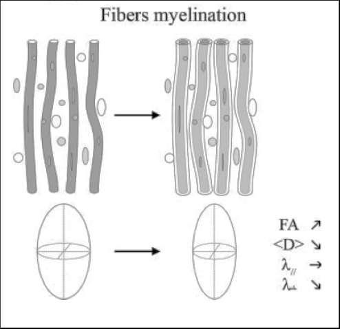 Diffusion changes as white matter matures Fiber organization Membranes proliferation FA MD AD RD FA MD AD RD Fiber myelination FA MD AD RD
