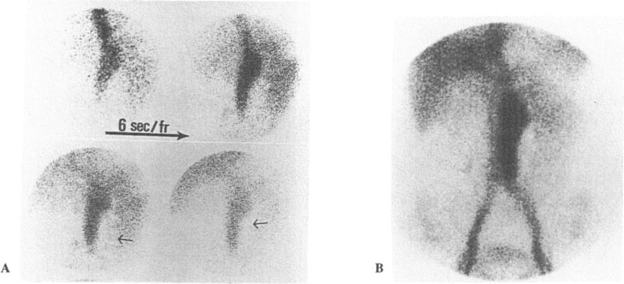 Fig. 3 Eccentric thrombus manifested by photopenia along one side of the lumen: A 57-yr-old man (5071, DK) was found
