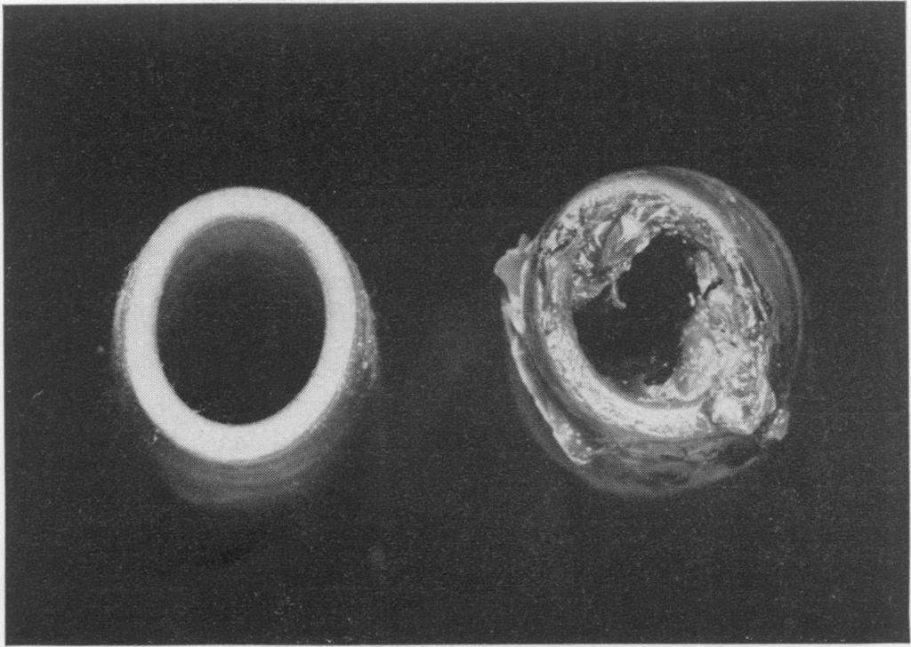 198 T. B. Stretton FIG. 1. End-on view of two tracheostomy tubes. The normal one on the left has an airflow resistance of 5 cm H2 1-1 sec1l.
