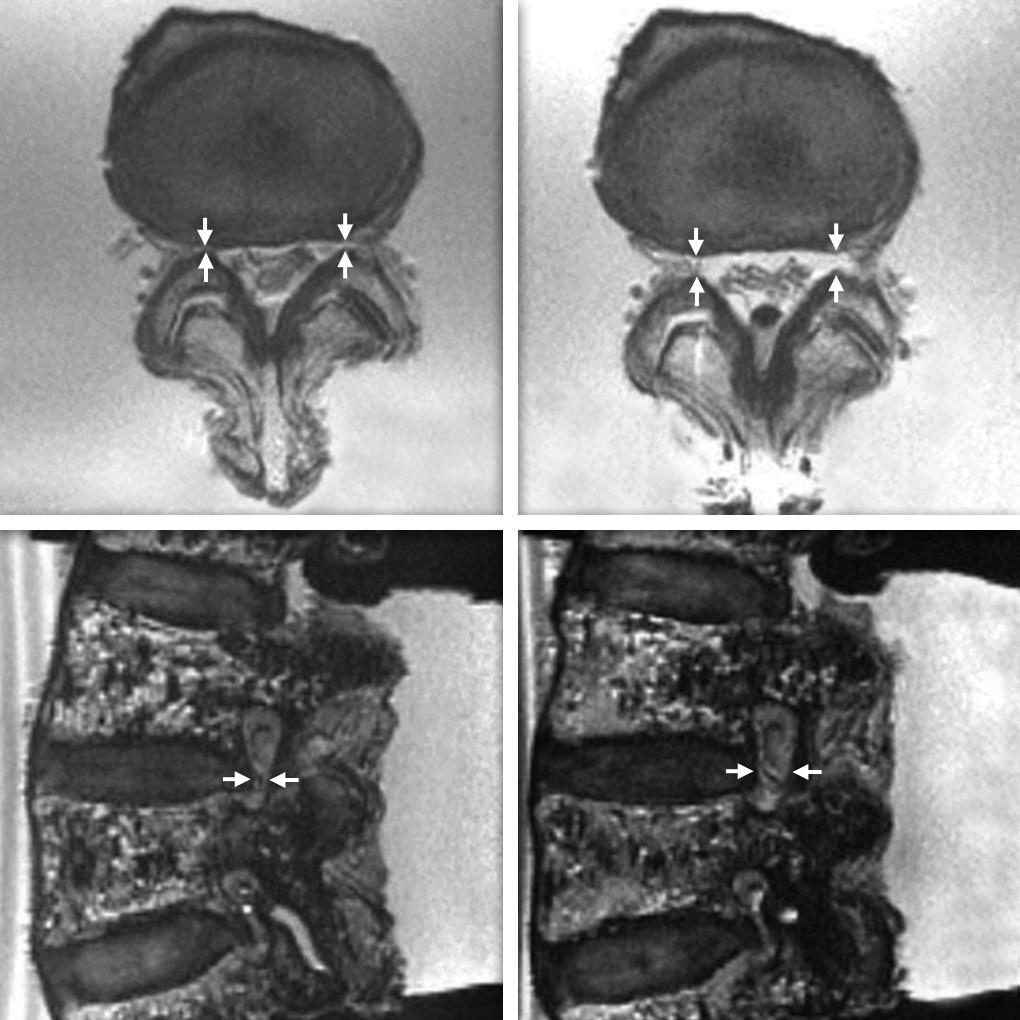 Chapter-54 Interspinous Spacers 461 A C B D Figs 2A to D: (A and B) Axial; (C and D) Pedicular plane magnetic resonance imaging of a specimen in the extended position with and