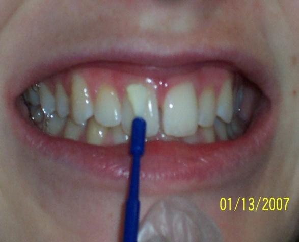 #4 Fluoride Treatment A flavored gel or foam will be placed in a soft tray and You will be asked to bite into That