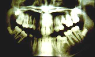 Numerical anomalies of teeth Missing teeth