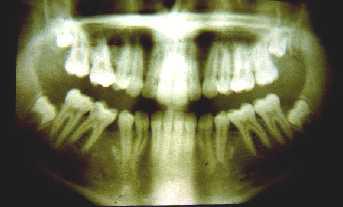 discrepancy problems Dental crossbite Angle