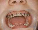 Accessory teeth
