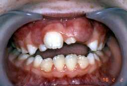Numerical anomalies of teeth Missing teeth Accessory