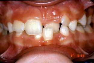 Numerical anomalies of teeth Missing teeth Accessory teeth Diastema medianum (midline space) Gross discrepancy problems