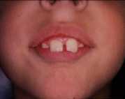 Numerical anomalies of teeth Missing teeth Accessory teeth Diastema medianum (midline space) Gross discrepancy