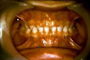 Numerical anomalies of teeth Missing teeth
