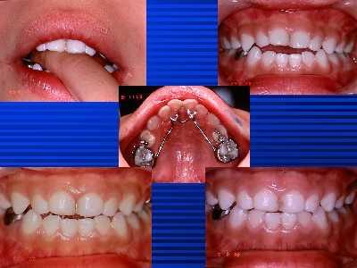 problems Dental crossbite Angle