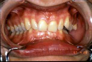 Numerical anomalies of teeth Missing teeth Accessory teeth Diastema medianum (midline space) Gross discrepancy