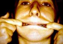 Myotherapy In the primary dentition: to prevent