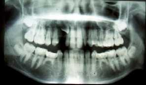 Gross discrepancy problems Dental crossbite Angle