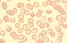Results of Participating Laboratories 11 E (All Parasites) Correct diagnosis: Plasmodium falciparum. Plasmodium falciparum 105/108 97 10/10 Correct Babesia sp.