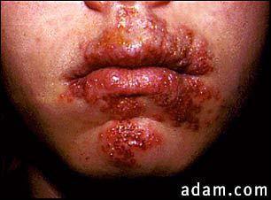 Recurrent Herpes Labialis Cold Sores Recurrent orpharyngeal infections occur in about 38% of the population Prodrone of pain, burning, tingling, followed by vesicles 24-48 hrs later