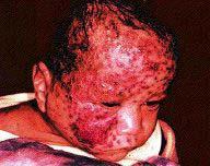 Neonatal herpes infections 1 in every 10,000 live births, infected through the birth canal Greatest risk in term mothers experiencing primary infection Majority asymptomatic, but symptoms may include