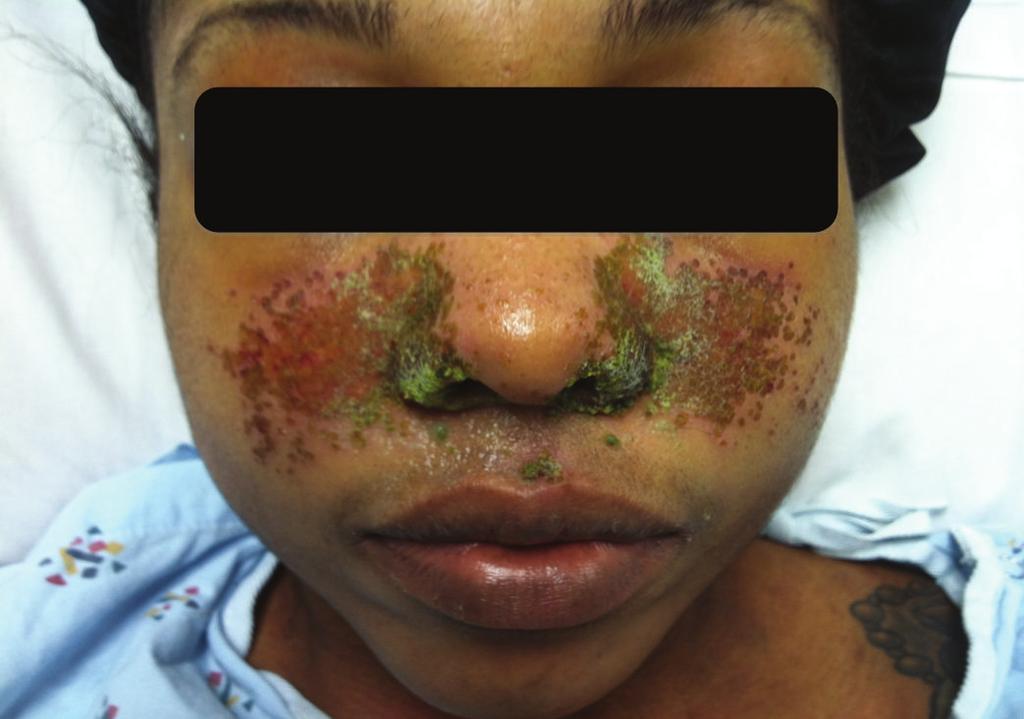 2 Case Reports in Hepatology Figure 1: Case 1 demonstrates facial eczema herpeticum.