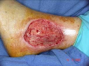 Wound Bed Preparation Progression Towards Healing Clean, viable wound