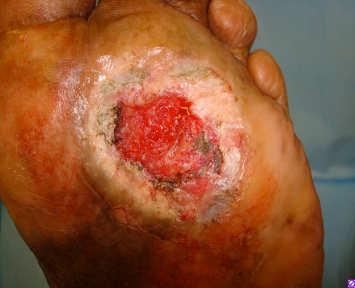left forefoot ulceration x 11 months Medical History: Diabetes Type 2 x 7