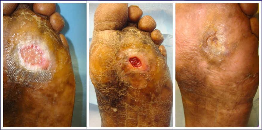 S/P Debridement, PTAL, Grafting Dressings do not heal wounds properly selected dressings