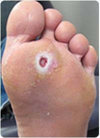 Background 80% of diabetes-related amps are preceded by a foot ulcer Up to 55%