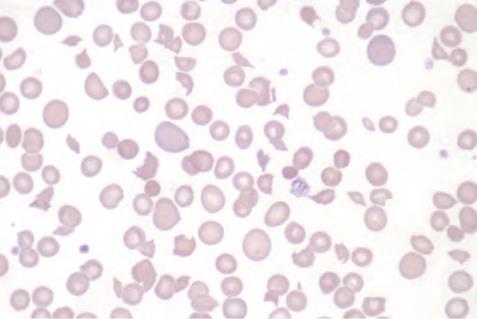 Blood film in microangiopathic haemolytic anaemia (in this patient Gram negative