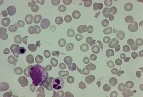 low platelets and