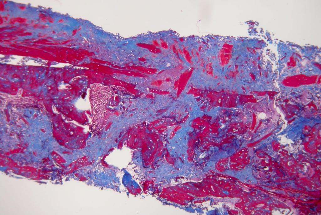 Figure 2. Bone marrow core histopathology, Masson s Trichrome. Bone marrow replaced by widespread fibrosis (green-blue).