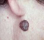 Skin lesions A part of the skin that has an abnormal growth or appearance compared to the