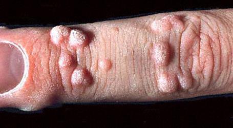 Viral Warts A small, rough, solid growth ( cauliflower ) Mostly on hands and feet Ten types (non-genital, genital), most are
