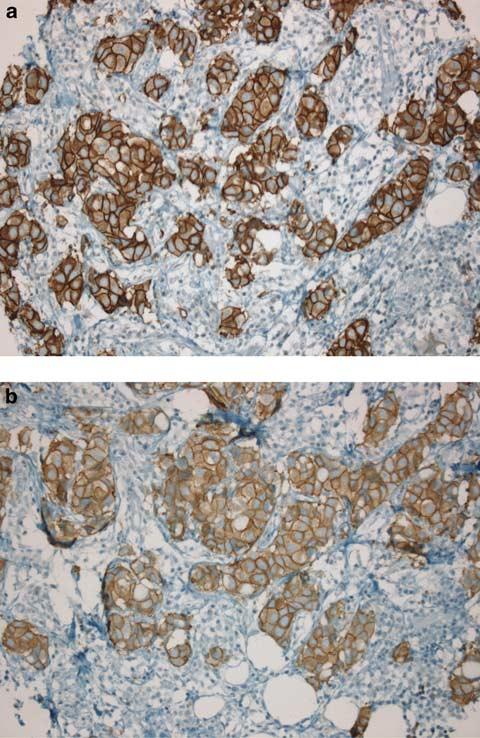monoclonal antibody, Ventana Medical Systems, Illkirch, Cedex, France) and mouse monoclonal antibody CB11 (PATHWAY HER-2/neu (CB11) mouse monoclonal antibody, Ventana Medical Systems) was performed